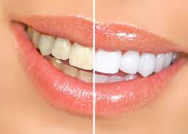 Oralzo teeth whitening in vienna va